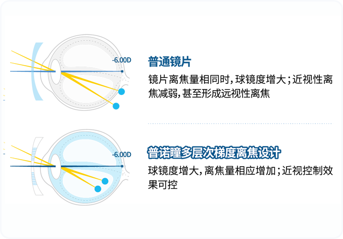 普诺瞳离焦镜